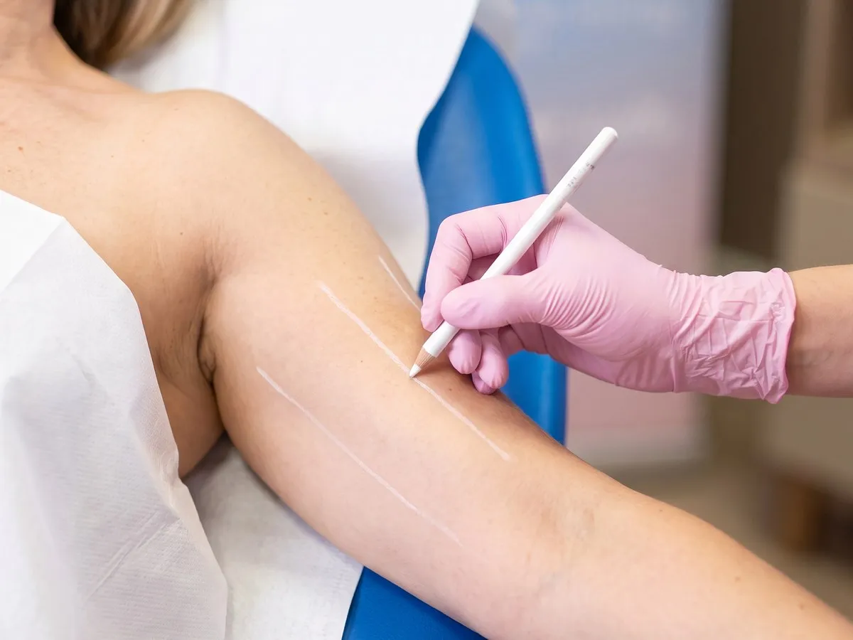 Acido Polilattico — trattamento corpo Leda Clinic